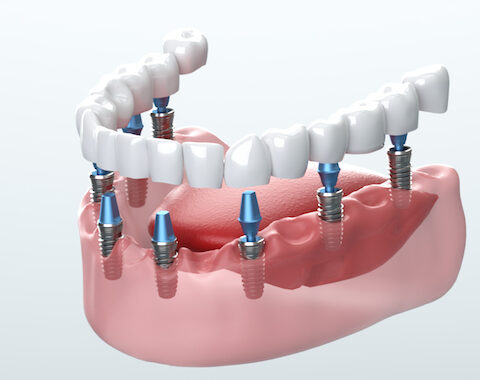 Dental Implants