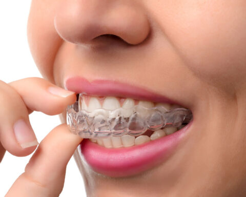 Invisalign Aligners