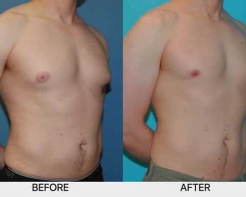 Body Contouring